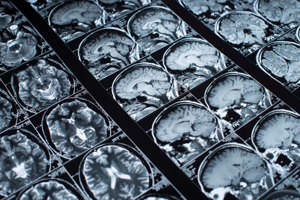Close-up view of several rows of black and white brain MRI scan images showing cross-sectional and side views of the brain.